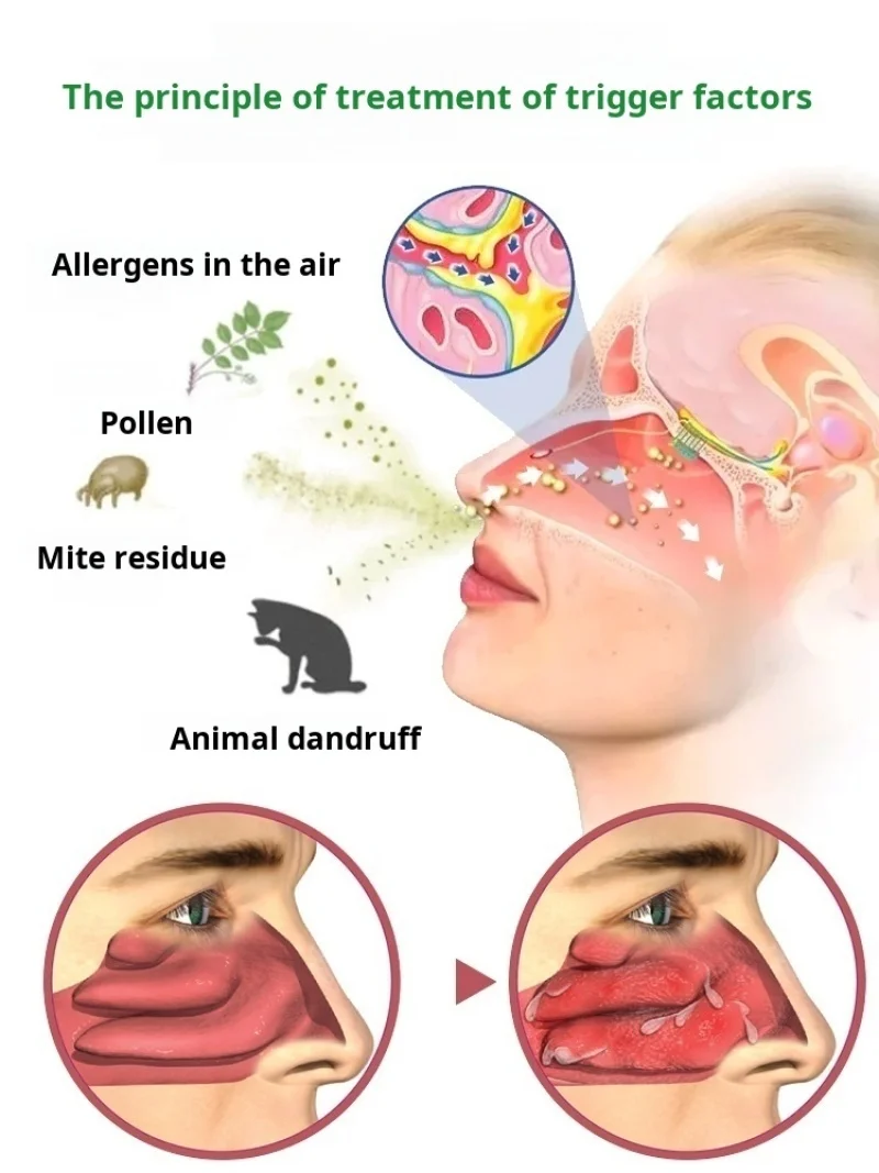 Neck Face Massager BioNase Nose Rhinitis Sinusitis Cure Therapy Nose Massage Hay Fever Low Frequency Pulse Laser Runny Sneeze Treatment Machine neck face massager electrotherapy skin care tool laser pen therapy skin care device