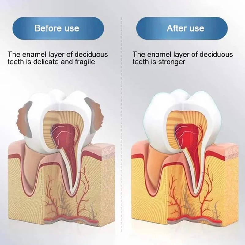 New Upgrade Quick Repair of Cavities Caries Removal of Plaque Stains Decay Whitening Yellowing Repair Teeth Teeth Whitening 6