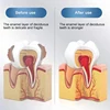 New Upgrade Quick Repair of Cavities Caries Removal of Plaque Stains Decay Whitening Yellowing Repair Teeth Teeth Whitening 6