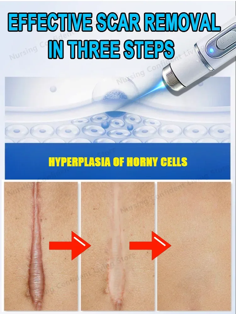 Laser scar repair 5