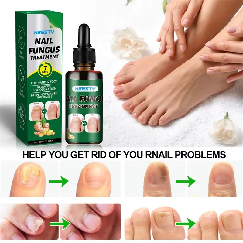 7Days Nail Fungus Treatment Serum Ginger Anti-infective Paronychia Onychomycosis Toe Foot Nail Fungal Repair Gel Hand Foot Care nail fungus treatment