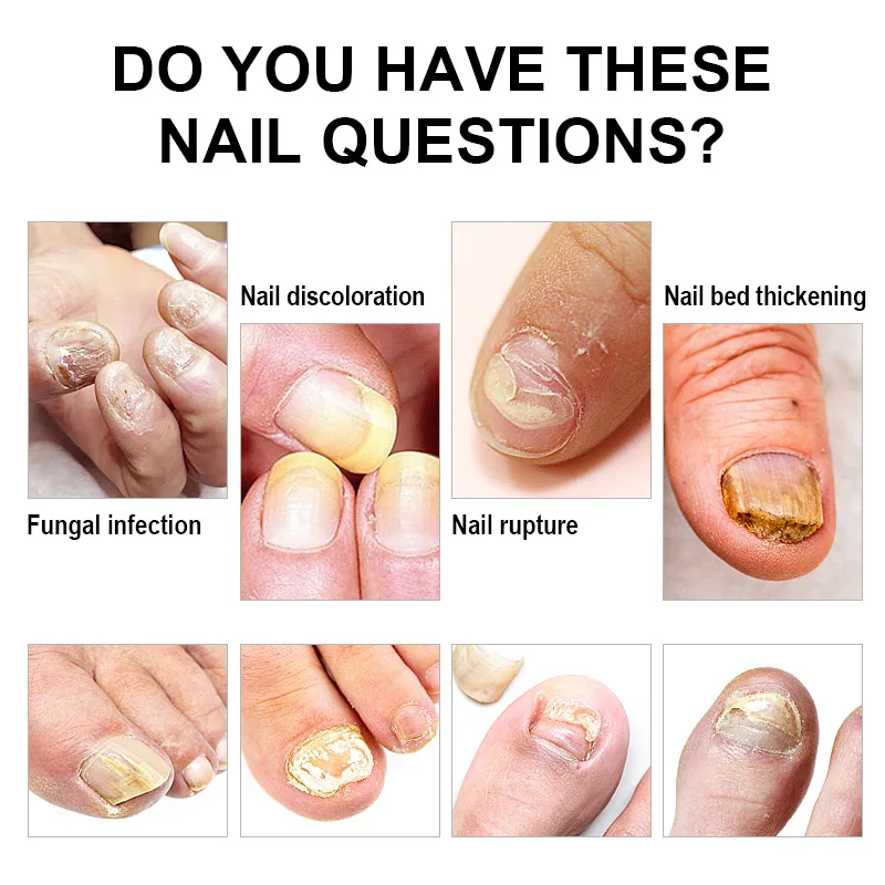 Nail Fungus Treatment Cream Onychomycosis Paronychia Anti Fungal Nail Infection Fights Bacteria and Fungus Naturally Oint U&ntilde;as nail fungus remover