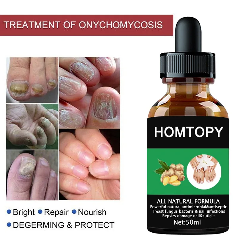 7 Days Nail Fungus Remover Serum Oil Foot Toe Nail Fungus Removal Repair Onychomycosi Anti Infection U&ntilde;as Care Products