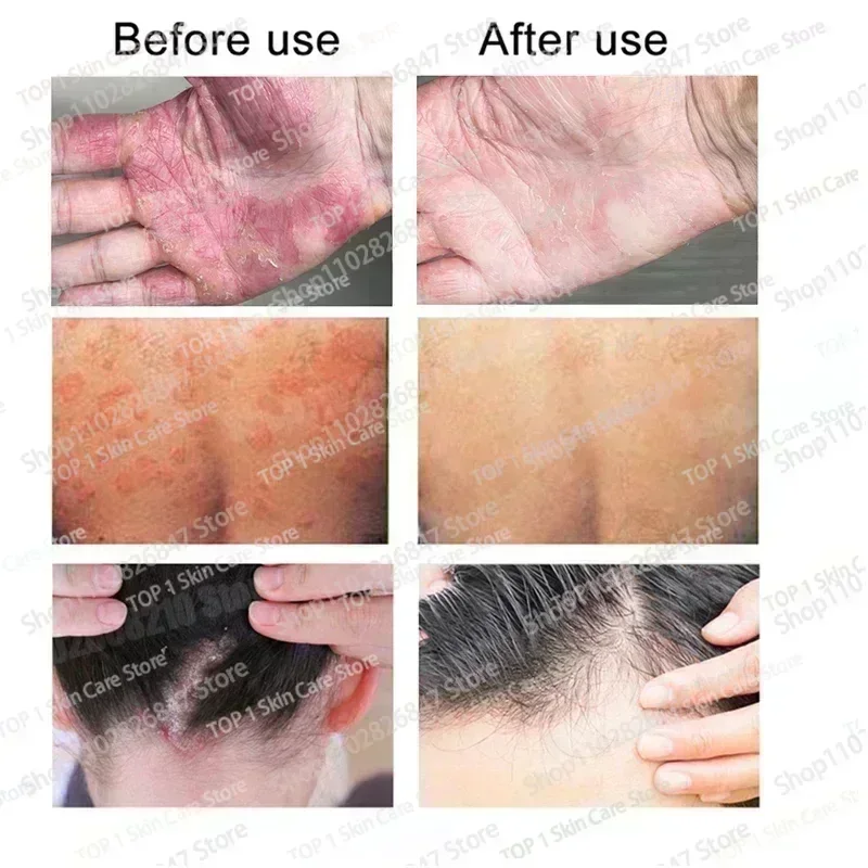 Psoriasis Antibacterial Anti-itch Dermatiti Eczema Urticaria Alergy Skin Beauty Health Body Care