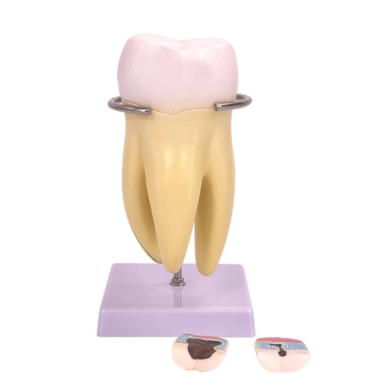 

Human Tooth Model Molar Tooth Anatomy Model, Dental Teeth Model for Clinic Setting and Doctor-patient Communication