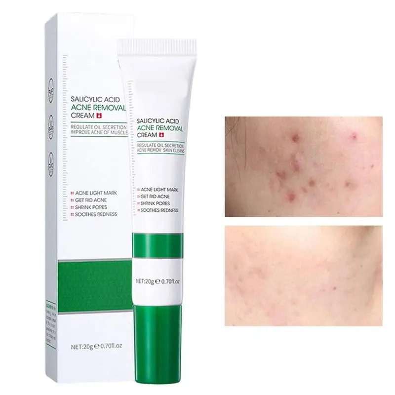 

Крем от прыщей быстрое облегчение прыщей точечный гель делает кожу нежной и гладкой, изящные поры, Активный Уход За прыщами, смягчает покраснения