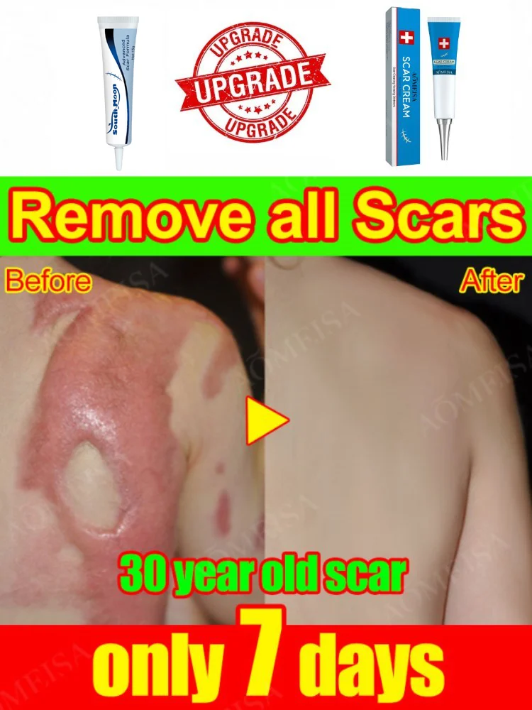 Remove Burn Scars Cream Gel Remove Stretch Marks Acne Spots Treatment
