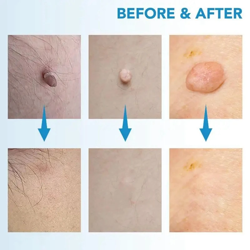 Skin Tag Removal Kit Painless Skin Tag Removal Pen Easy Device Removes 4Mm-9Mm Tags