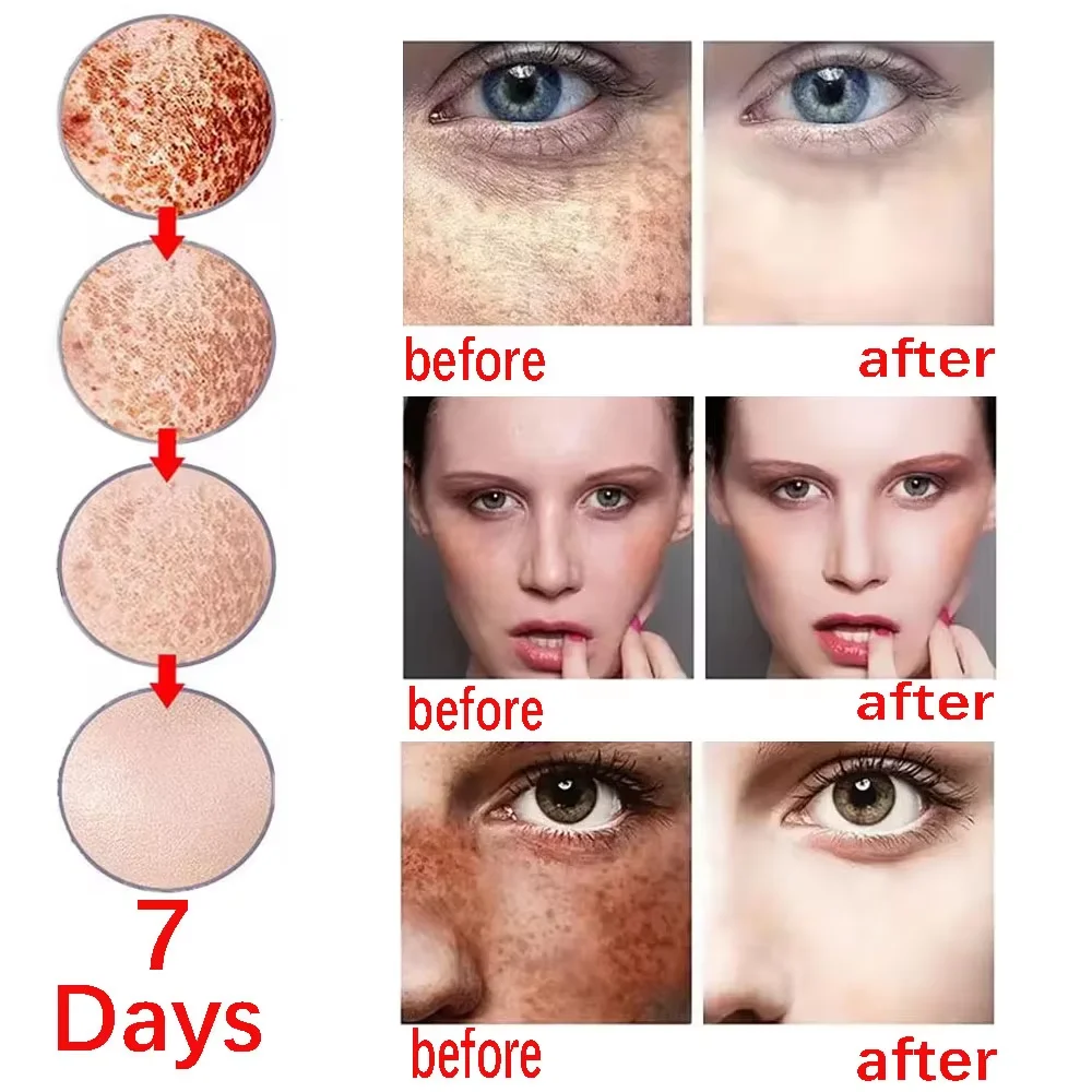 Niacinamide Whitening Freckles Serum Removal Melasma Dark Spots