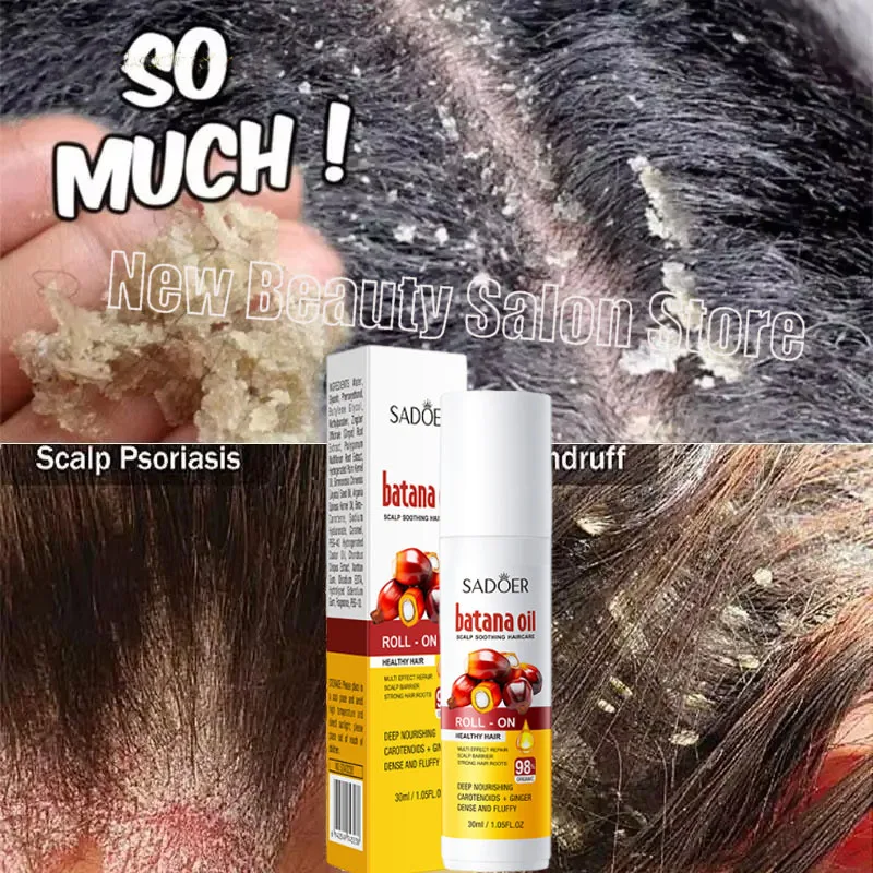 Hair Scalp Treatment Essence Anti Dandruff Itching Oil Control Anti Loss Scalp Cleaning Repair Serum Beauty Hair Care Products