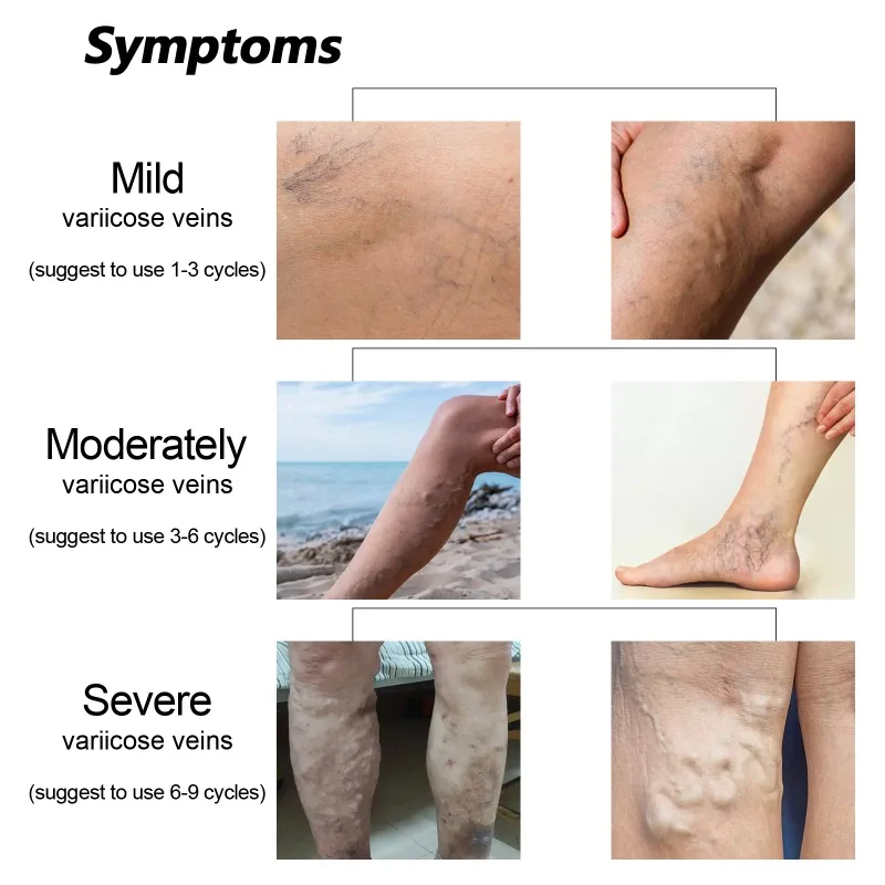 Varicose Veins Gel Phlebitis Worm Spider Legs Vessel Pain Professional Treatment Soothing Reduce Swelling Repair Cream