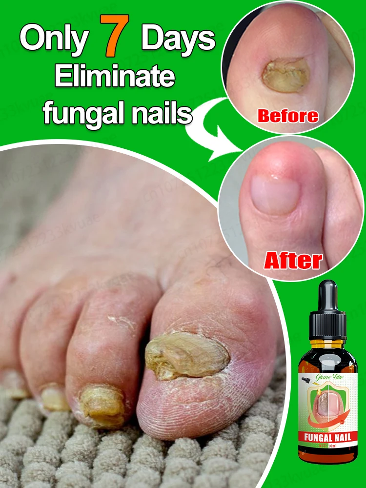 Fungus solution nail fungus treatment essential oil repair onychomycosis in 7 days