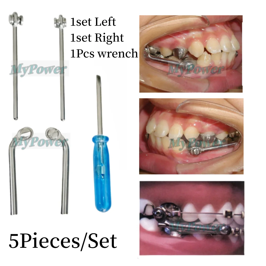 What Is A Herbst Appliance? - Orthodontist Parkersburg Ripley WV