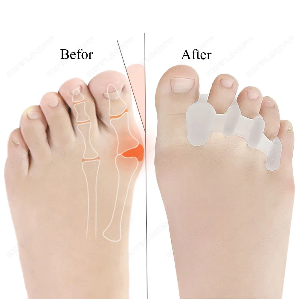 Toe Pads Toe Protective Toes Separator Silicone Bunion Hallux Valgus Toe Overlap Corrector Soft Gel Straightener Spacers Stretchers Care