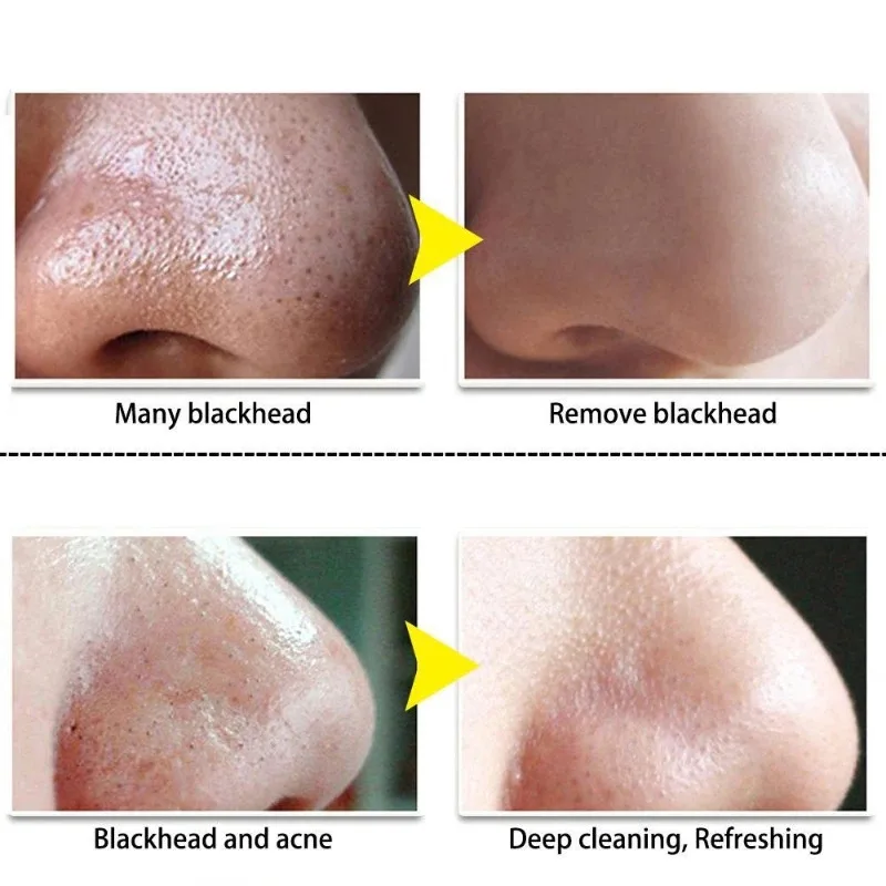 Charcoal Blackhead Remove Mask Black Dots Spots Acne Treatment Mask Nose Sticker Cleaner Nose Pore Deep Clean Strip Acne removal acne remover,blackhead nose strips,blackhead remover