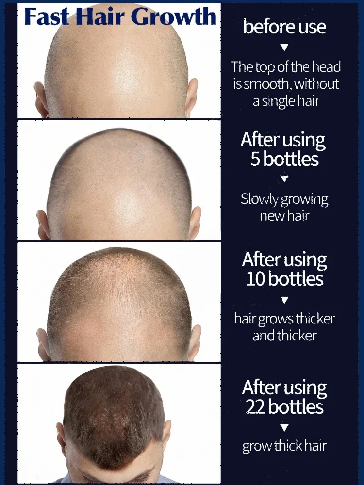 Sérum anti-chute de cheveux pour hommes et femmes, croissance rapide des cheveux, traitement à l'huile capillaire, produits de traitement du cuir chevelu, beauté et santé, vidéo 6