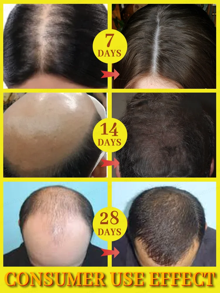 Produits croissance des cheveux dites adieu calvitie perte de cheveux 99% avis positifs