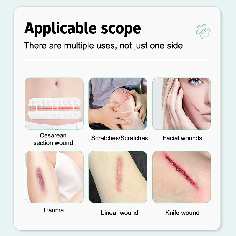 Band-Aid Zipper Tie Wound Closure Patch Hemostatic Patch Wound Fast Suture Zipper Band-Aid Outdoor Portable wound bandage,medical wound dressing,tattoo adhesive bandages