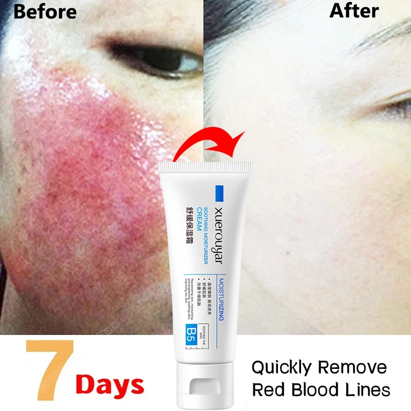 

Repair Facial Redness Cream 7 Day Soothing Repair Rosacea Red Blood Cellulite Shrink Pores Sensitive Skin Care Korean Cosmetic