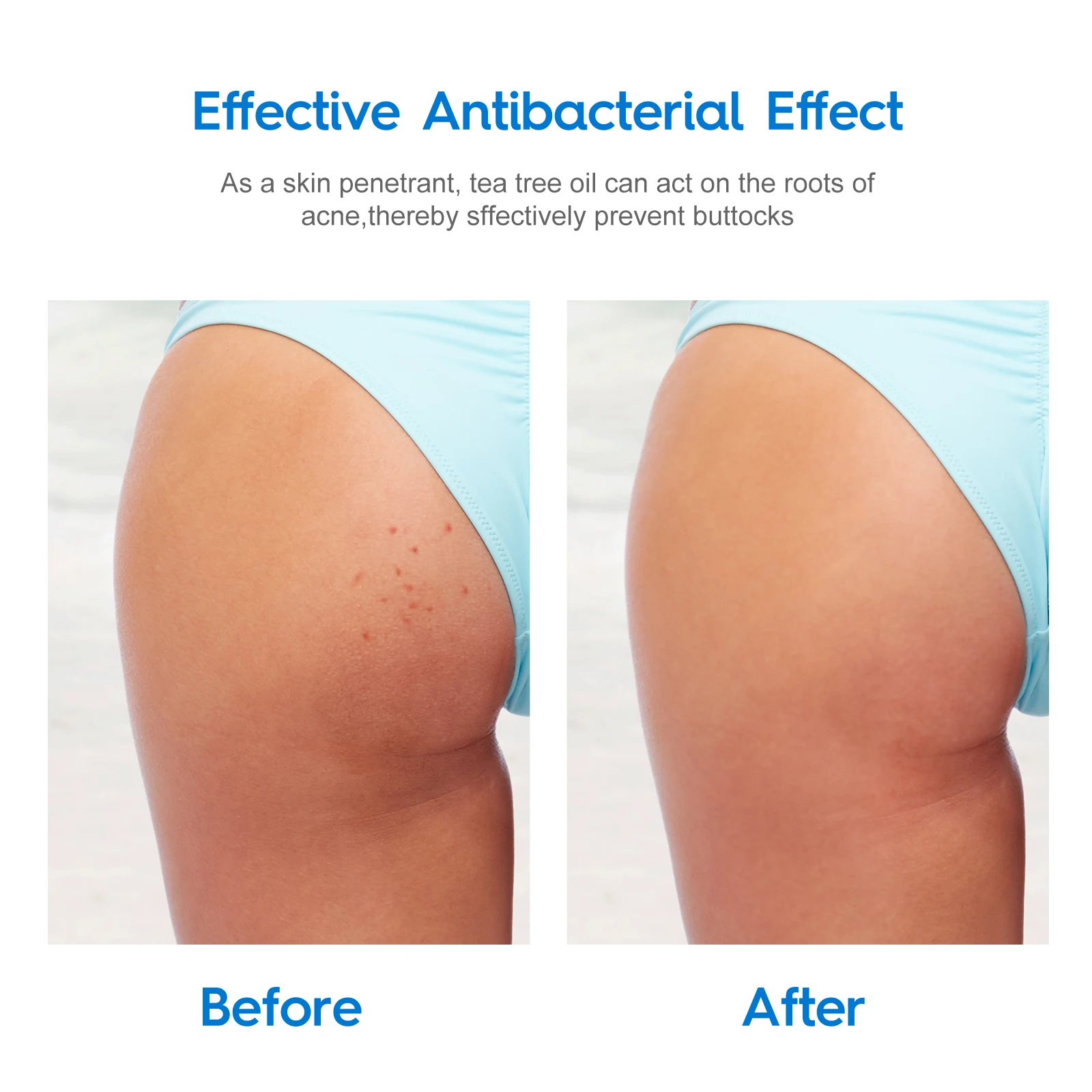 Pimples On Buttocks Crack - Acne Between The Buttocks Crawler Symptoms
