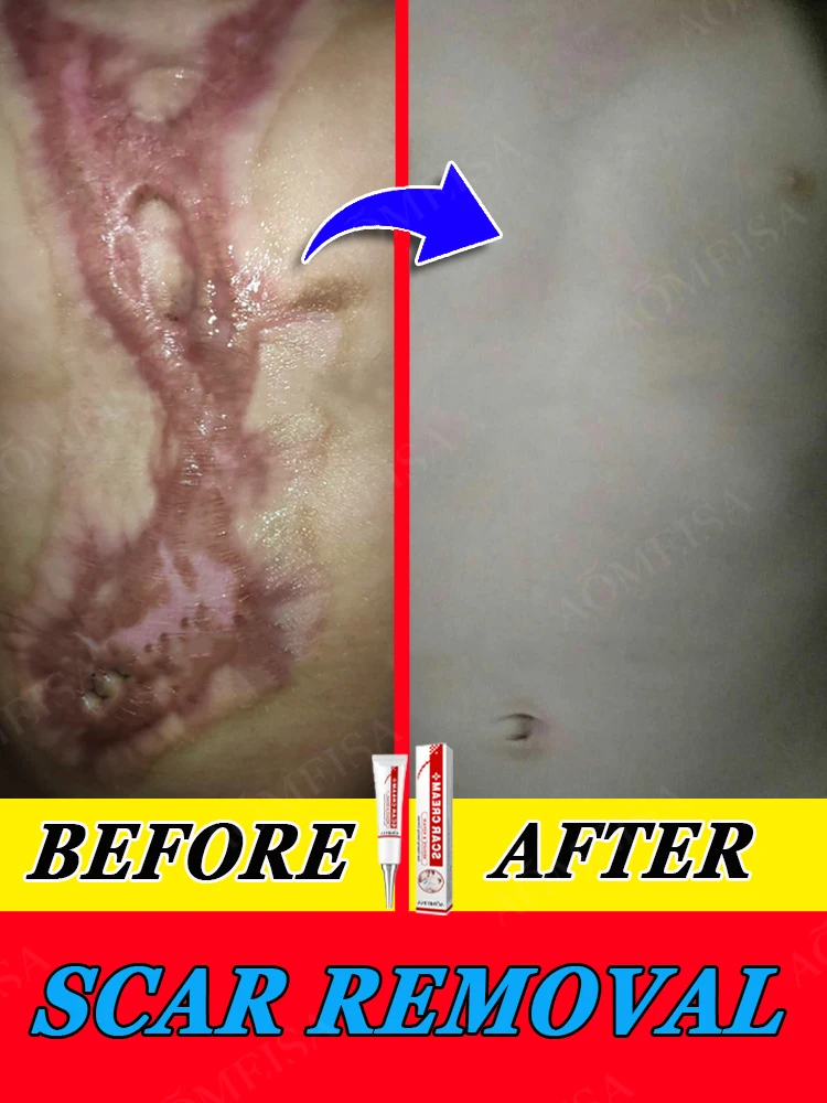 Surgicalscarremovalointmenttoremovecesareansectionstretchmarks