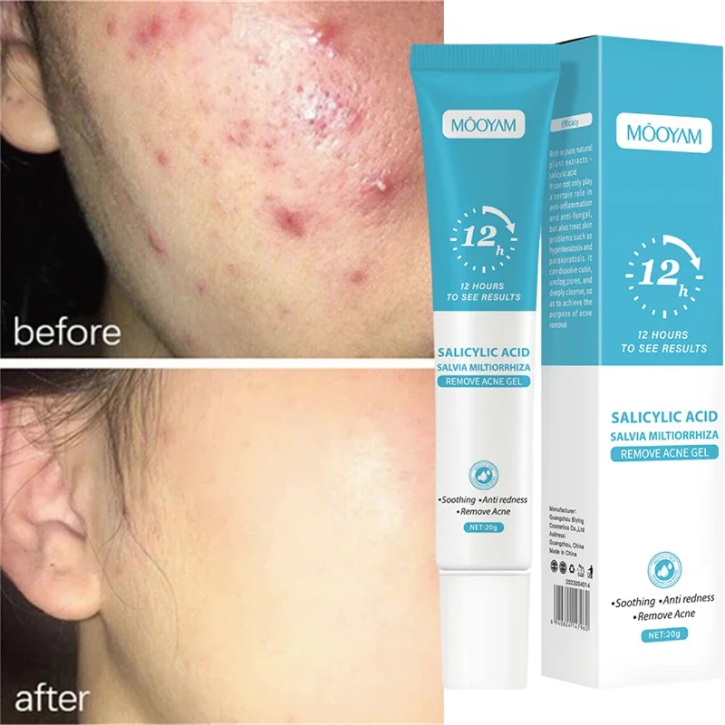 

Acne Cream Salicylic Acid Anti-Acne Gel Repair Acne Scar Oil Control Shrink Pores Remove Acne Whitening Moisturizing Skin Care
