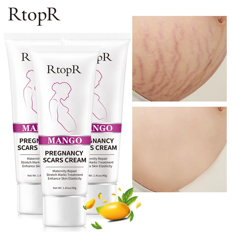 

Крем Для Удаления растяжек с манго RtopR, восстанавливает кожу и улучшает растяжки, уход за кожей для беременных женщин, отбеливает уход за кожей