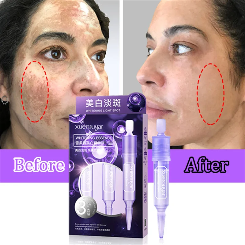 

Freckles Whitening Serum Remove Dark Spot Brighten Skin Essence Anti-Aging Fade Pigment Melasma Melanin Face Care Beauty Health