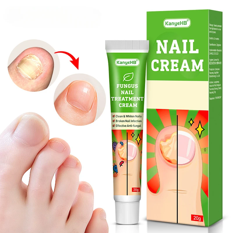 Nail Fungus Treatment Cream Onychomycosis Paronychia Anti Fungal Nail Infection Fights Bacteria and Fungus Naturally Oint U&ntilde;as nail fungus remover