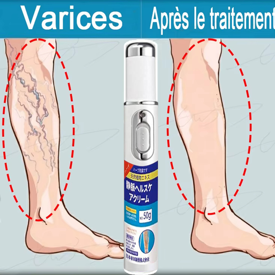 Laser pen for varicose veins, enlarged veins, spider legs, pain, unsightly veins, new laser pen for varicose veins