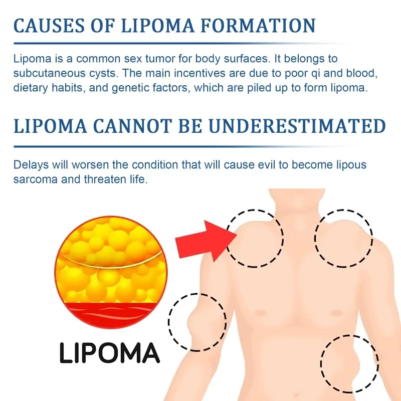 Lipoma Removal Patch Remove Fat Lump Nodular Sticker Anti-Tumor Cellulite Treat Skin Cyst Swelling Pain Relief Medical Plaster
