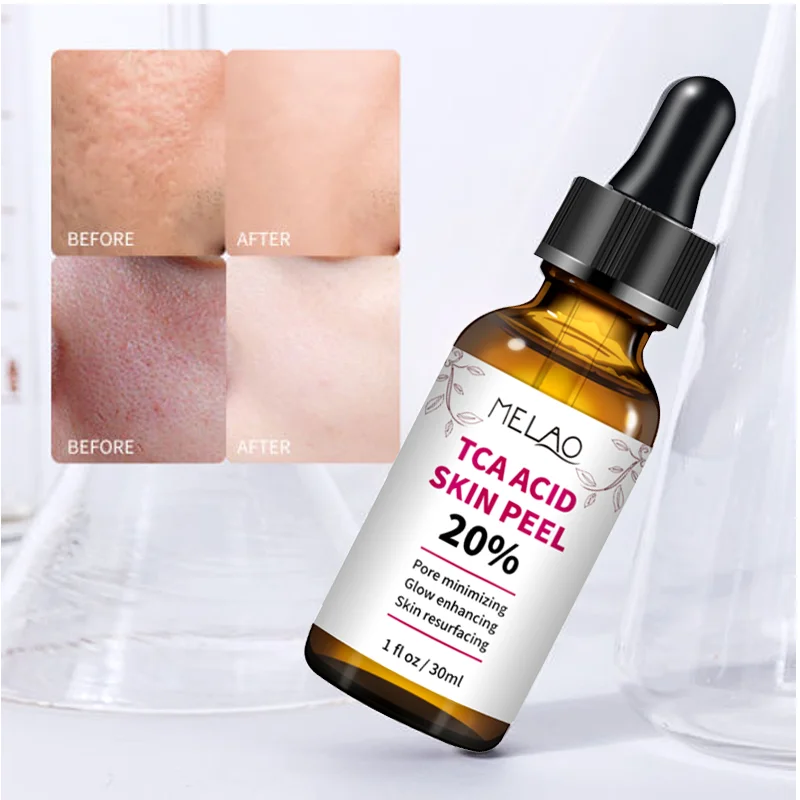 30ml skórki kwas trichlorooctowy roztwór TCA pielęgnacja skóry wybielanie chemiczne wybielanie Serum 20% Melao TCA kwas skóry Teel 1Pc