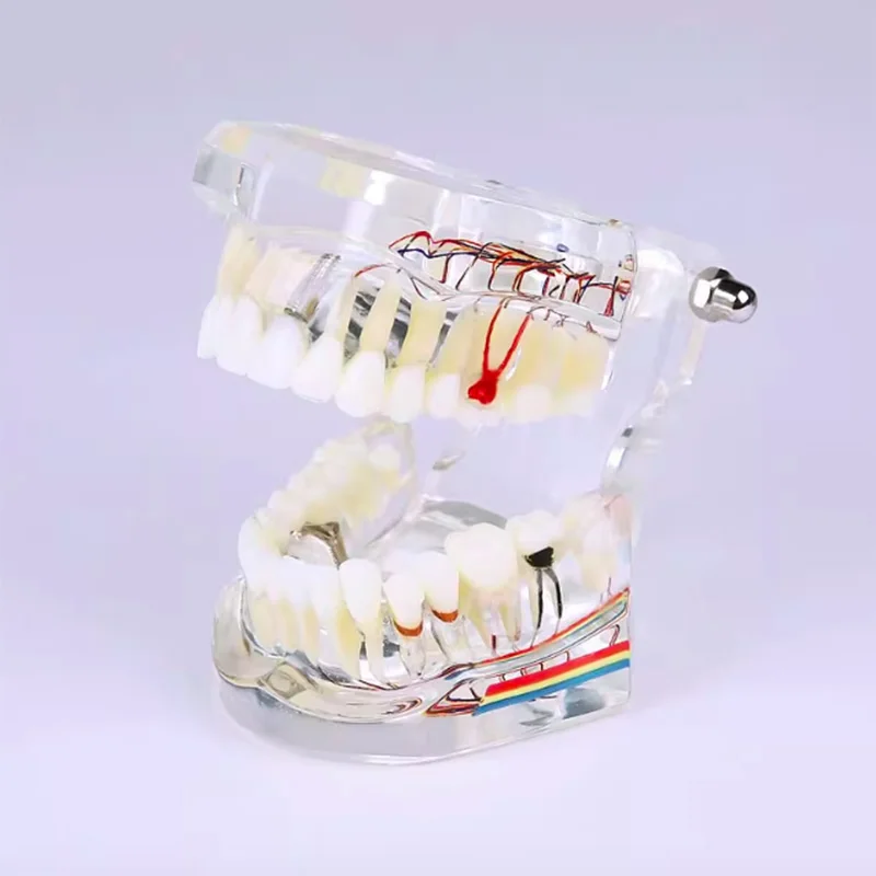 

DENTAL Neural Repair Dental Model Implant Disease Teeth Model Dentist Standard Pathological Removable Teeth Teaching Model