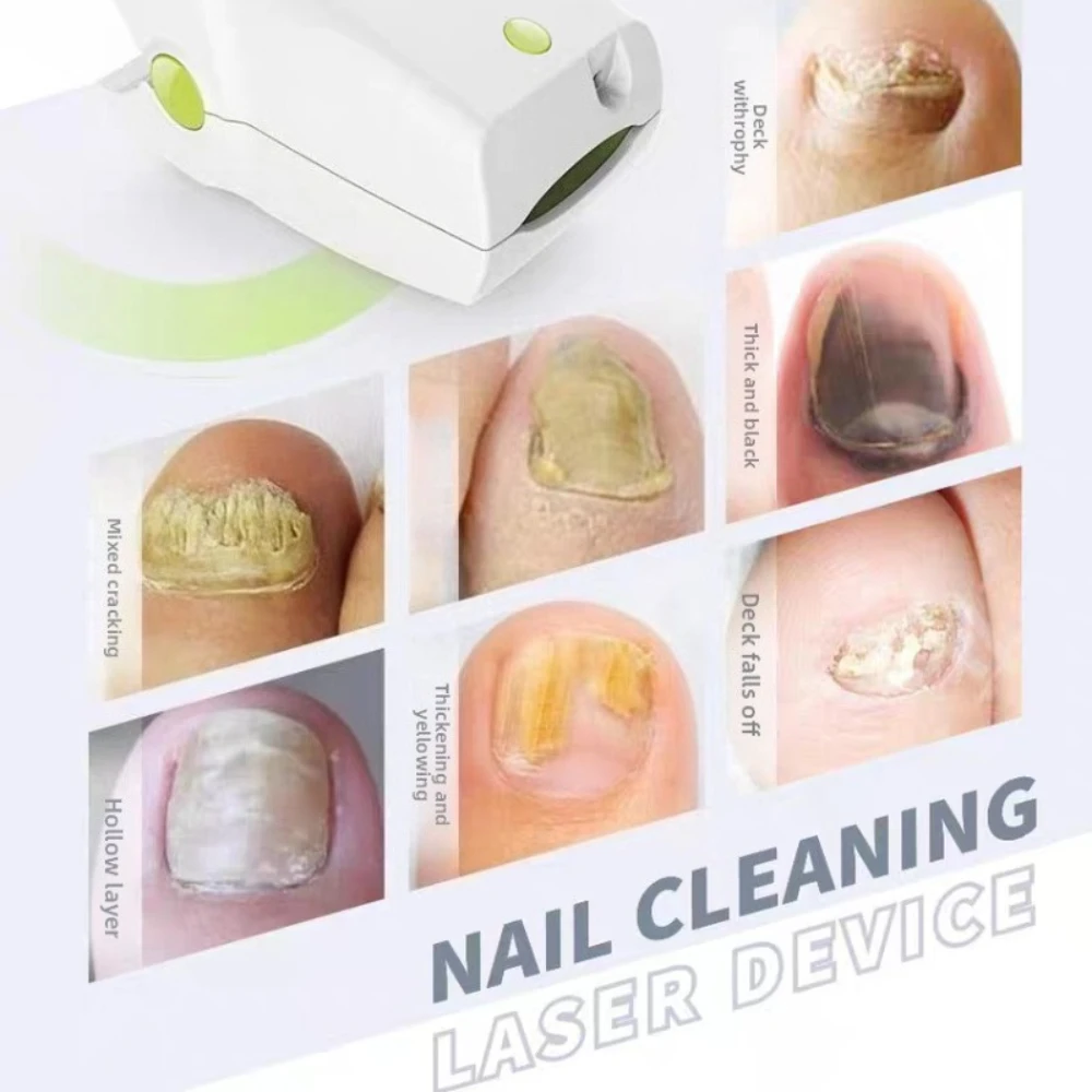Laser Nail Fungus Remover - Professional Onychomycosis Treatment Device for Healthy Nails