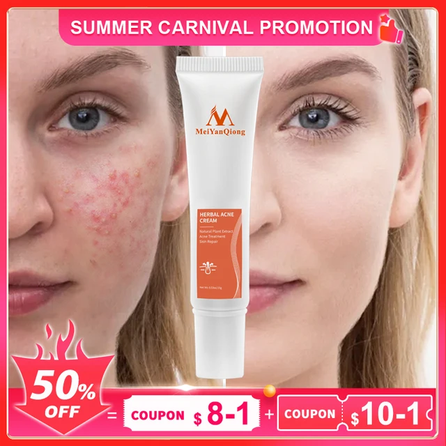 Acne Cream: O Segredo para uma Pele Livre de Imperfeições