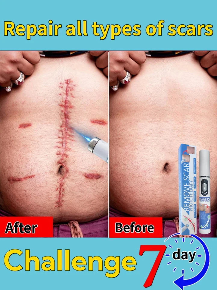 `Laser Scar Hot 𝐒𝐜𝐚𝐫 𝐫𝐞𝐦𝐨𝐯𝐚𝐥 𝐬𝐜𝐚𝐫 𝐫𝐞𝐜𝐨𝐯𝐞𝐫𝐲 𝐫𝐚𝐩𝐢𝐝 𝐫𝐞𝐦𝐨𝐯𝐚𝐥 𝐨𝐟 𝐬𝐮𝐫𝐠𝐢𝐜𝐚𝐥 𝐬𝐜𝐚𝐫𝐬