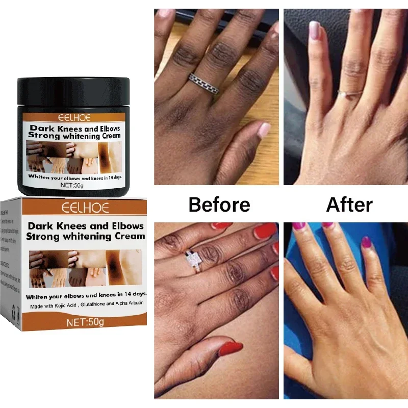 Dark Colored Quick Whitening Cream Skinpowerful Stain Remover Knuckles Correction for Dark for Knuckles Elbows and Knees