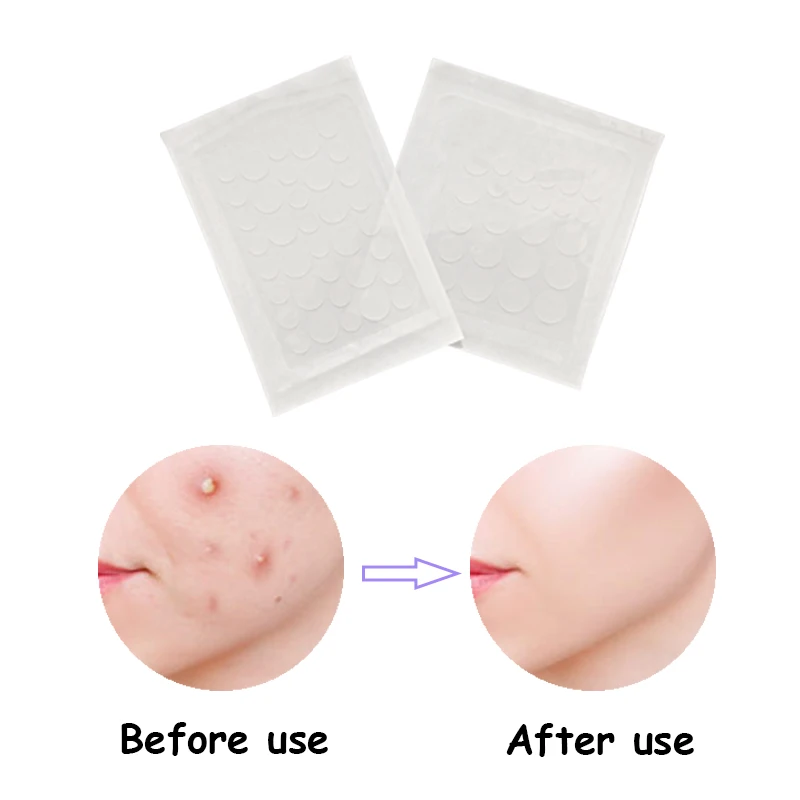 48/72 pcs Acne Pimple Patch Sticker Acne Treatment Pimple Remover Tool Blemish Spot Facial Mask Skin Care маска для лица маска трехступенчатая антивозрастная elizavecca anti aging egf aqua mask pack