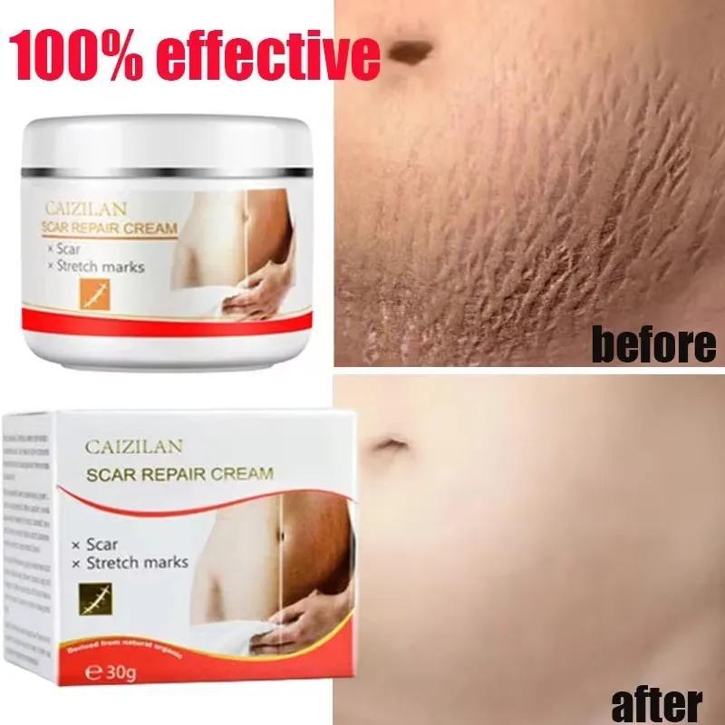 Stretch Marks Permanent Removal Cream Eliminate Body Belly Stretch Marks Swelling Remove Skin Cracks Repair Firming Care