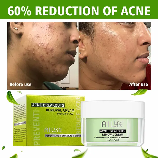 Ailke Szalicilsav Szerves Anti-Acne Tisztító Arckezelés, Sima, Tiszta És Pattanásokmentes Bőr, Csökkentse A Pattanások Hegét, Foltokat, Kitörést - Image 4