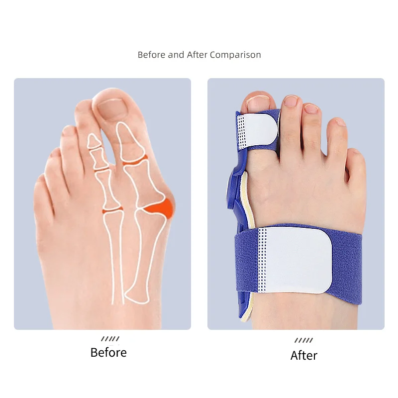 Hallux Valgus Corrector Bunions For Toes Corrector Foot Finger Separator Finger Separator Splint Foot Care Bunion 2Pcs