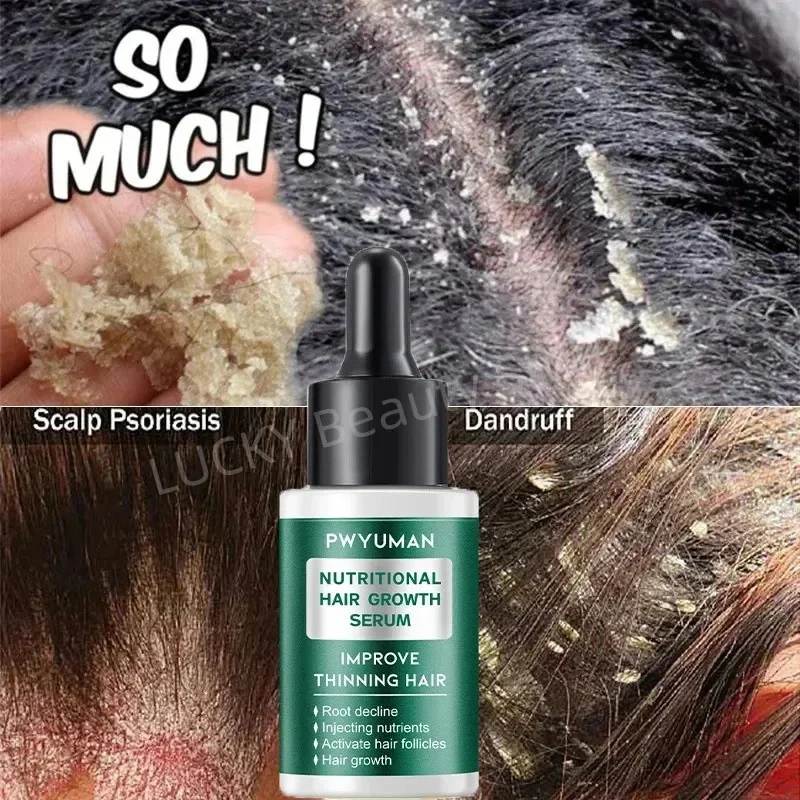 Hair Scalp Treatment Essence Spray Dandruff Itching Oil Control Anti Loss Scalp Cleaning Repair Serum Beauty Hair Care Products hair treatment scalp treatment