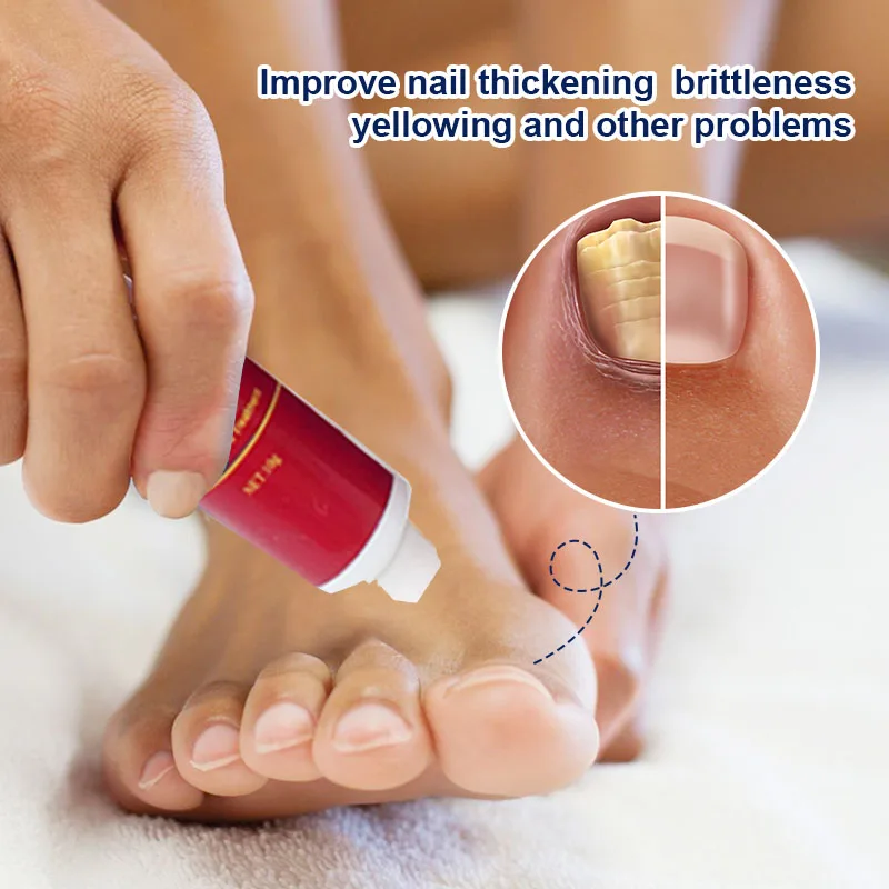 Treatment Fungal Nail Ointment Care Repair Foot Nail Fungus Removal Cream Anti Infection Paronychia Onychomycosis Product
