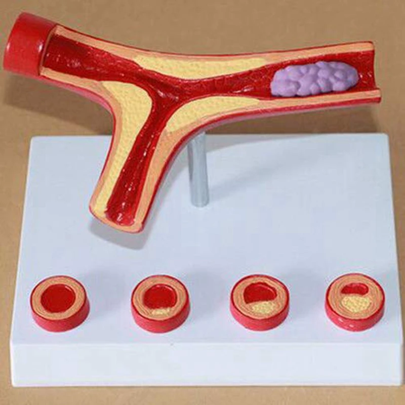 

Прибор для обучения атеросклерозу человека, модель сосудистой анатомии, ветка атеросклероза