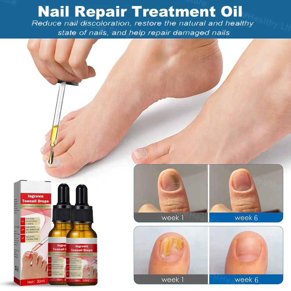 Nail Fungus Remover Laser Device for Onychomycosis 910nm 407nm