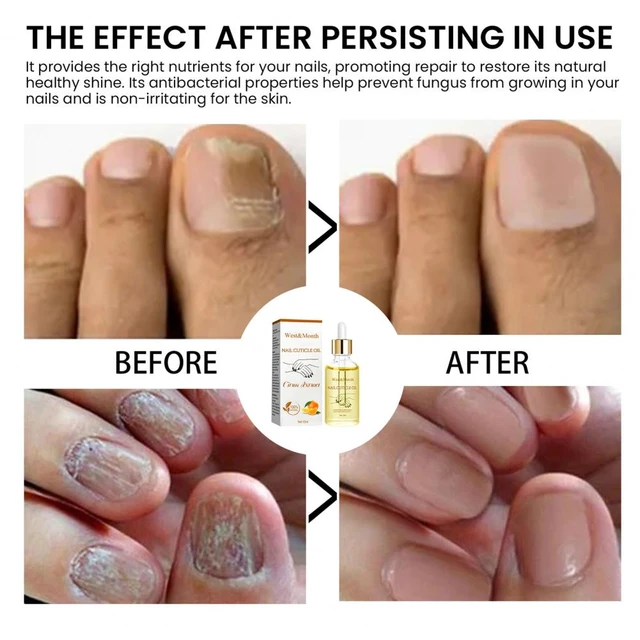 Before and after successful treatment for a onychomycosis or fungal nail  infection on damaged nails after gel polish, onychosis. Longitudinal  ridging nails with psoriasis, nail diseases. Stock Photo | Adobe Stock