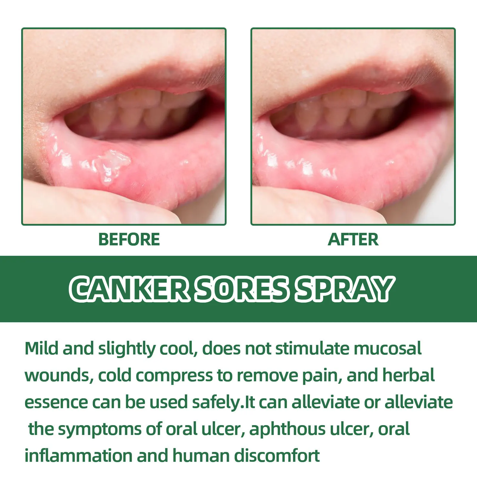 Oral Ulcer Spray 20ml herbal oral spray Canker Sores Swelling in The Gum Fresh Breath and Mouth Ulcer Care Spray Belleza Y Salud Oral Care