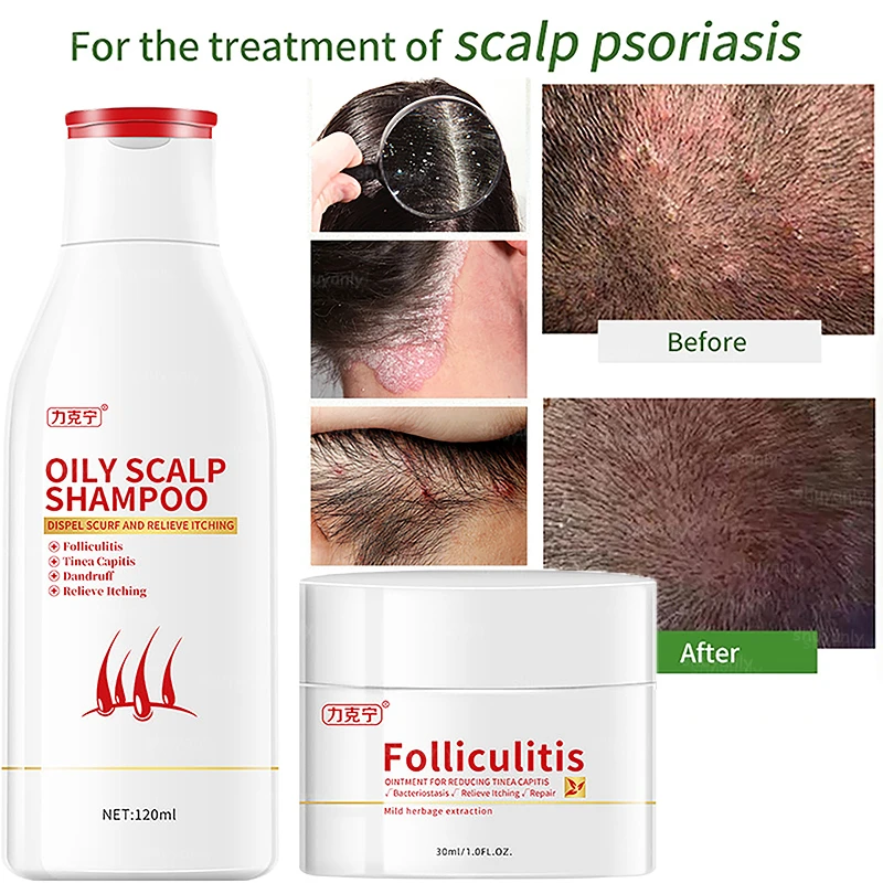 Scalp Folliculitis Natural Treatment