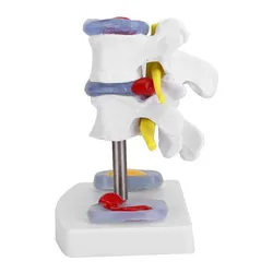 Anatomical Lumbar Disc Herniation Demonstration Model Human Spine School Training Supplies
