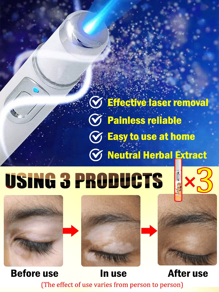 2세대 업그레이드된 백반증 치료제 ? 백반증 치료 ? 빠르게